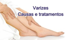 Conheça as causas e tratamentos para varizes